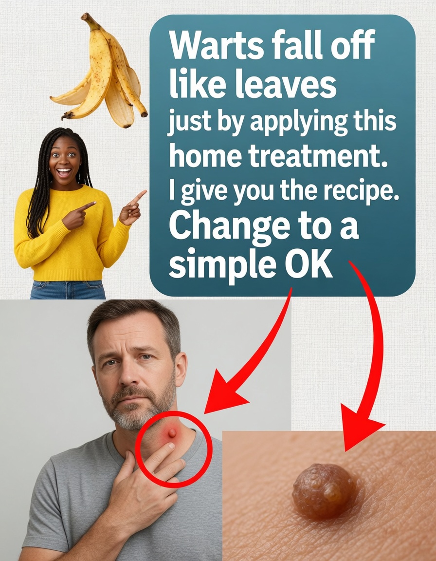Warts Fall Off Like Leaves With This Simple Home Treatment