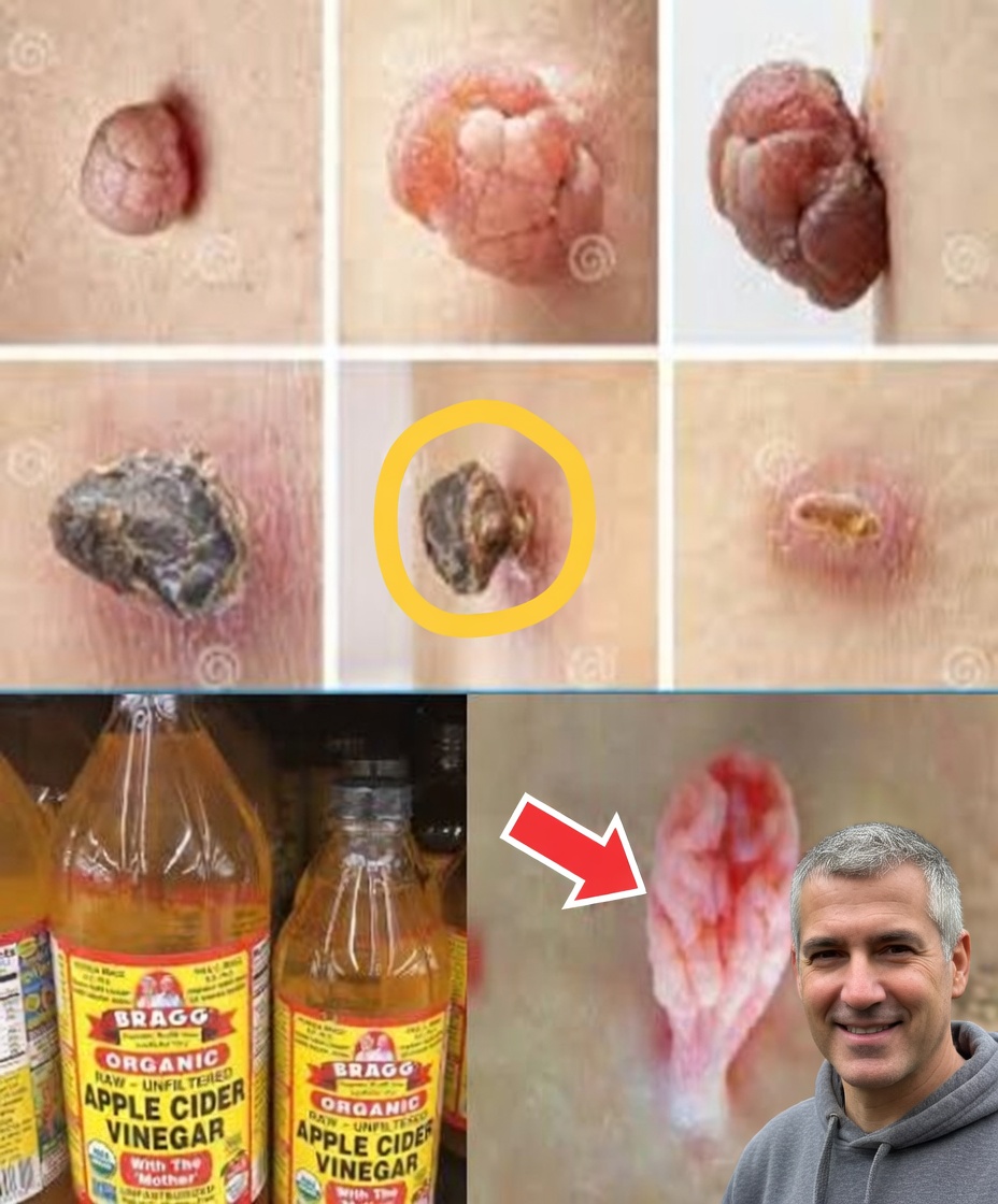 Plantar Warts and Skin Tags Disappear Naturally—Try This Overnight Remedy