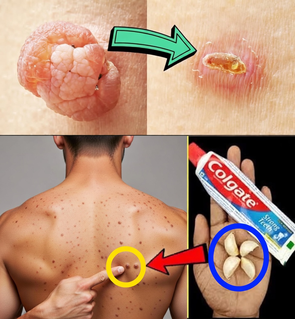 Plantar Warts and Skin Tags Disappear Naturally—Try This Overnight Remedy
