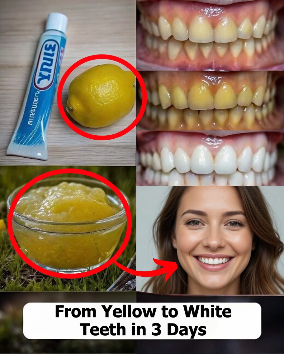 Natural Mixture to Whiten Yellow Teeth at Home in One Day Without a Dentist