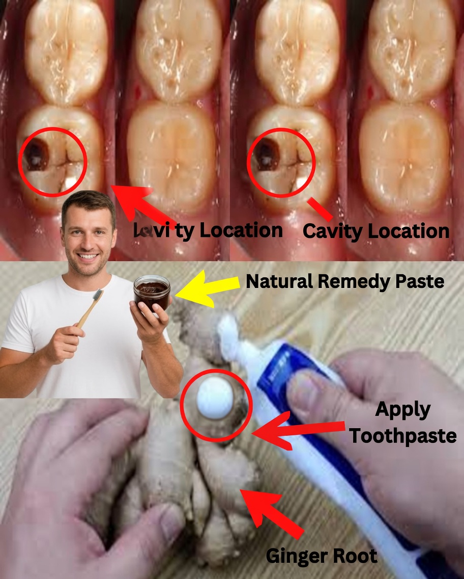 How to Naturally Repair a Cavity: Keep These Tips in Mind to Avoid Visiting the Dentist