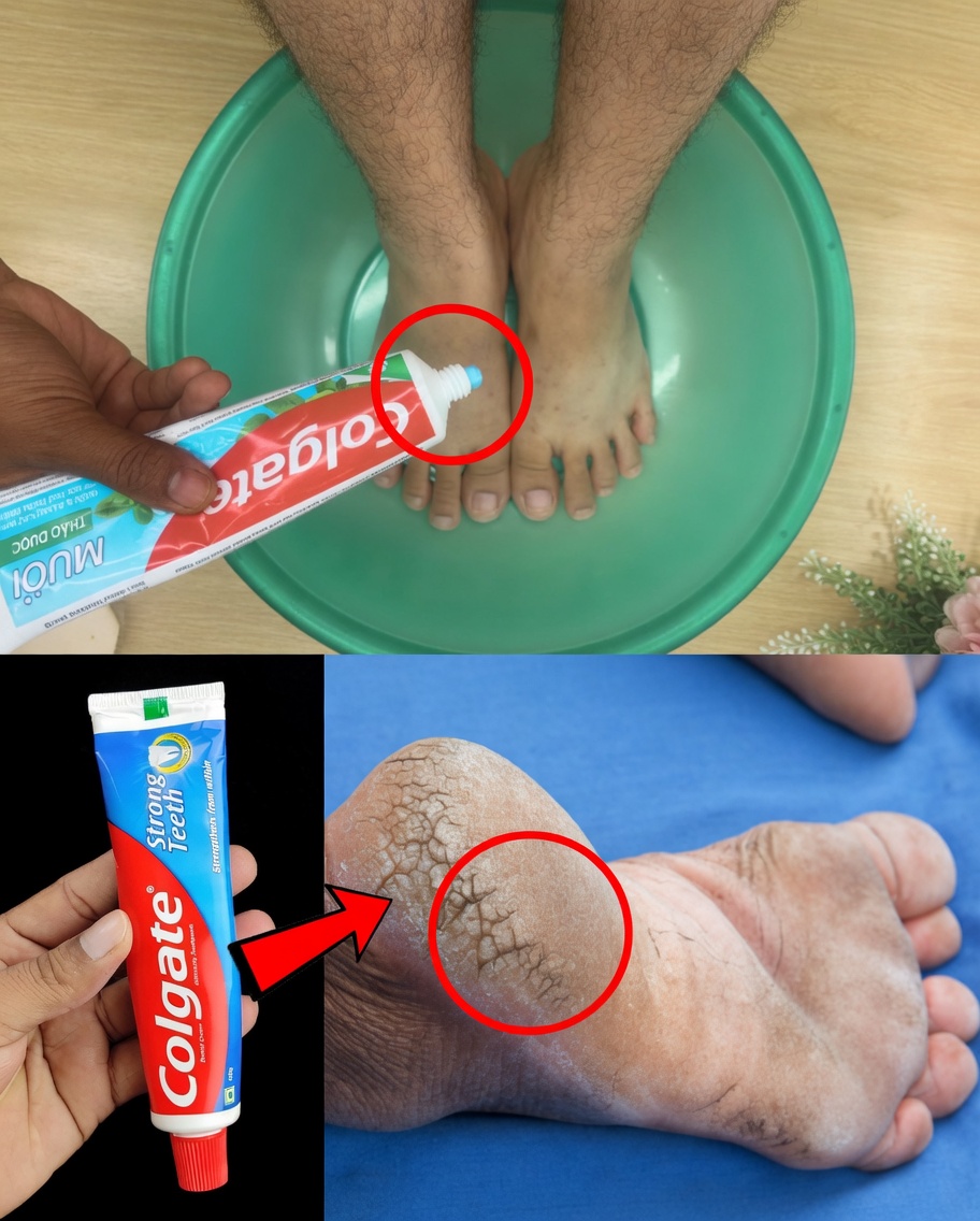 Remove Cracked Heels and Get Beautiful Feet Permanently in 3 Days: Home Remedy Using Toothpaste